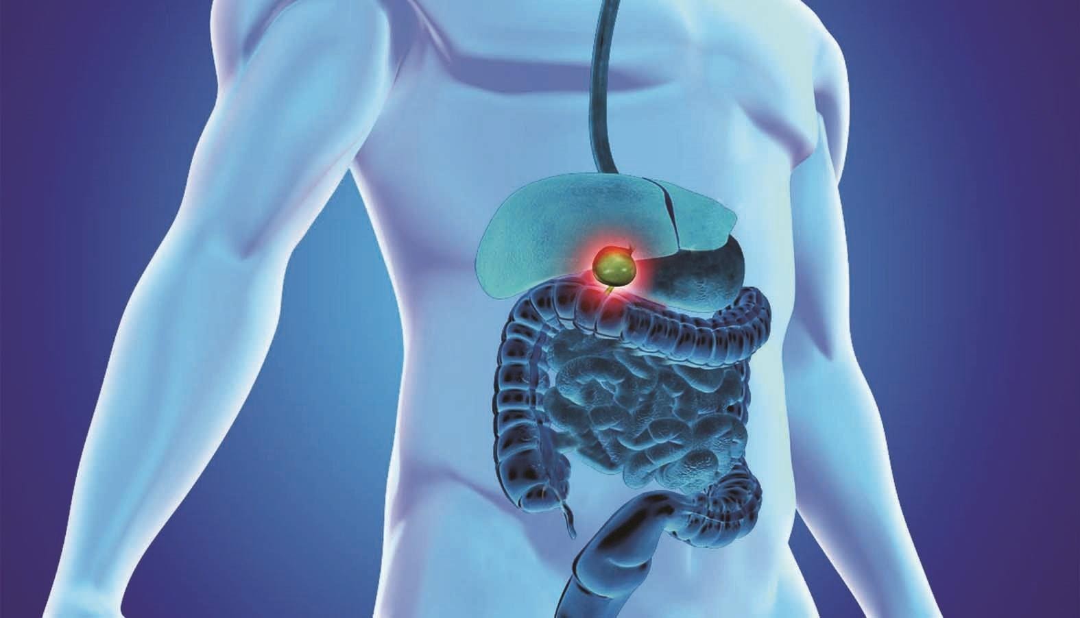 Gallbladder Stone