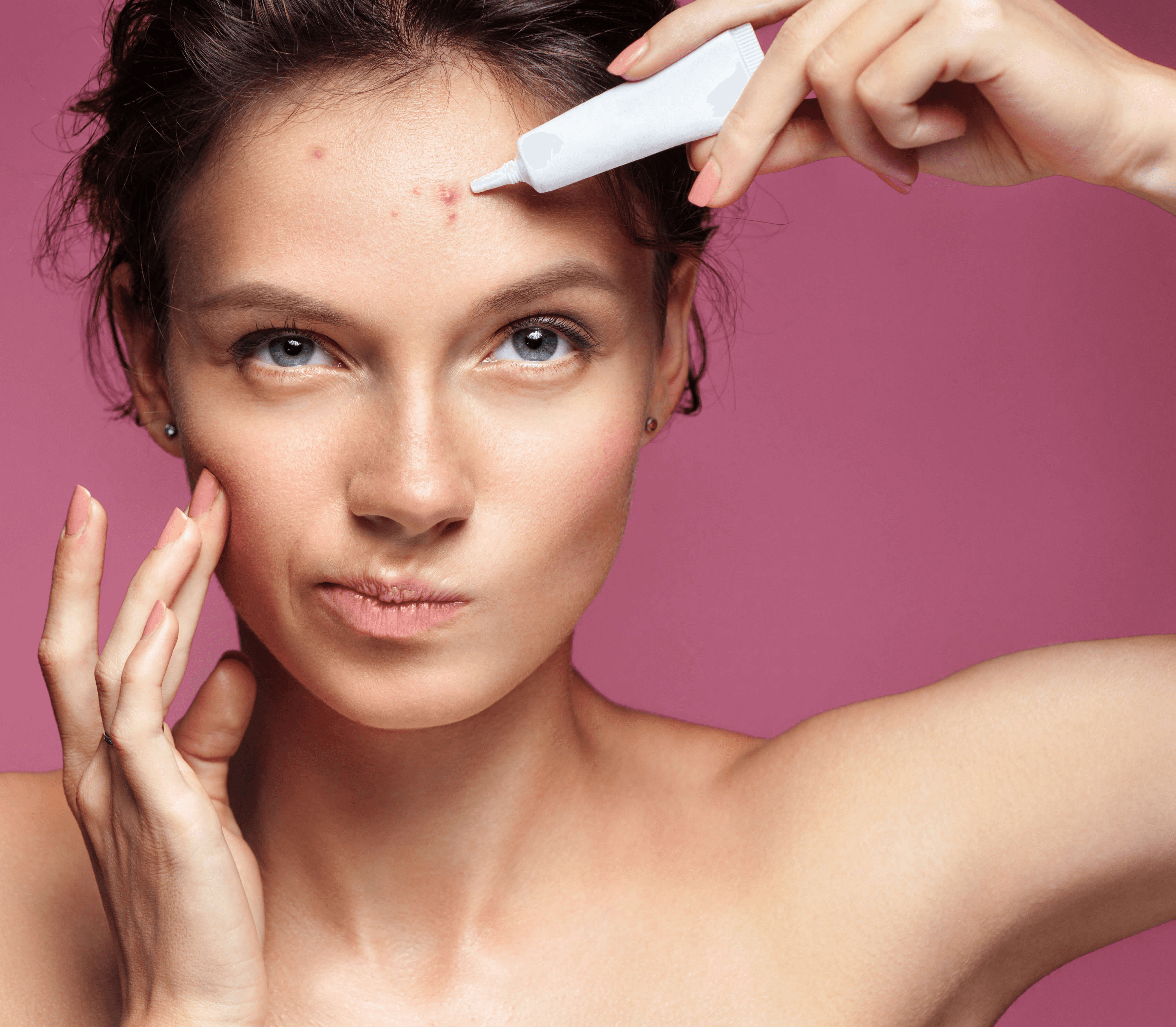 Młoda kobieta precyzyjnie aplikuje produkt na trądzik ropowiczy, pielęgnacja skóry problematycznej.