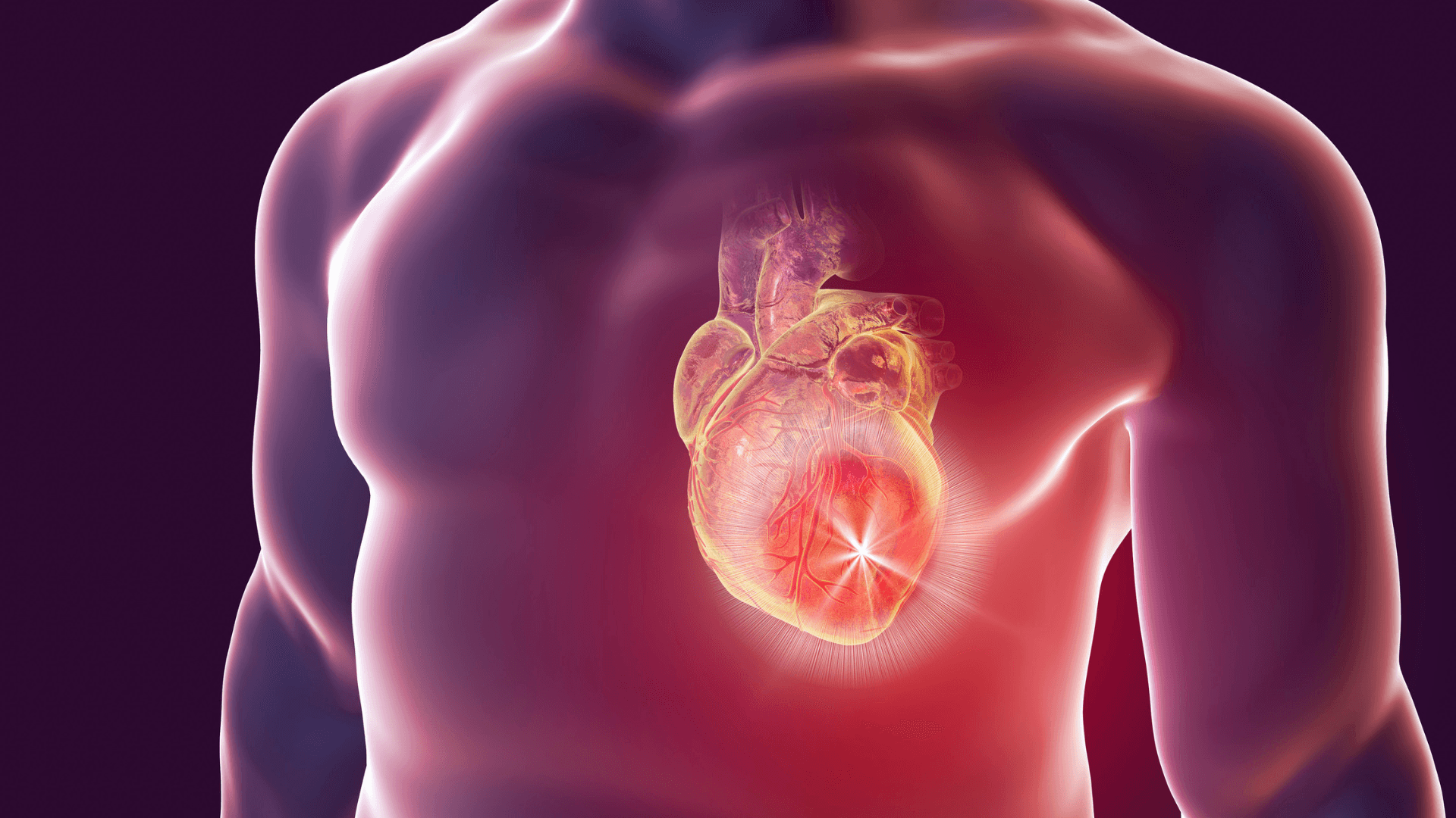 parodontite infarctus du myocarde