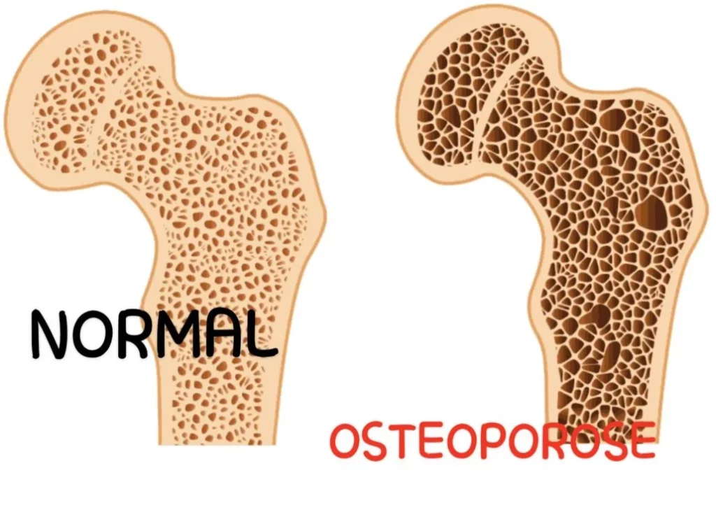 difference between normal bone and osteoporotic bone