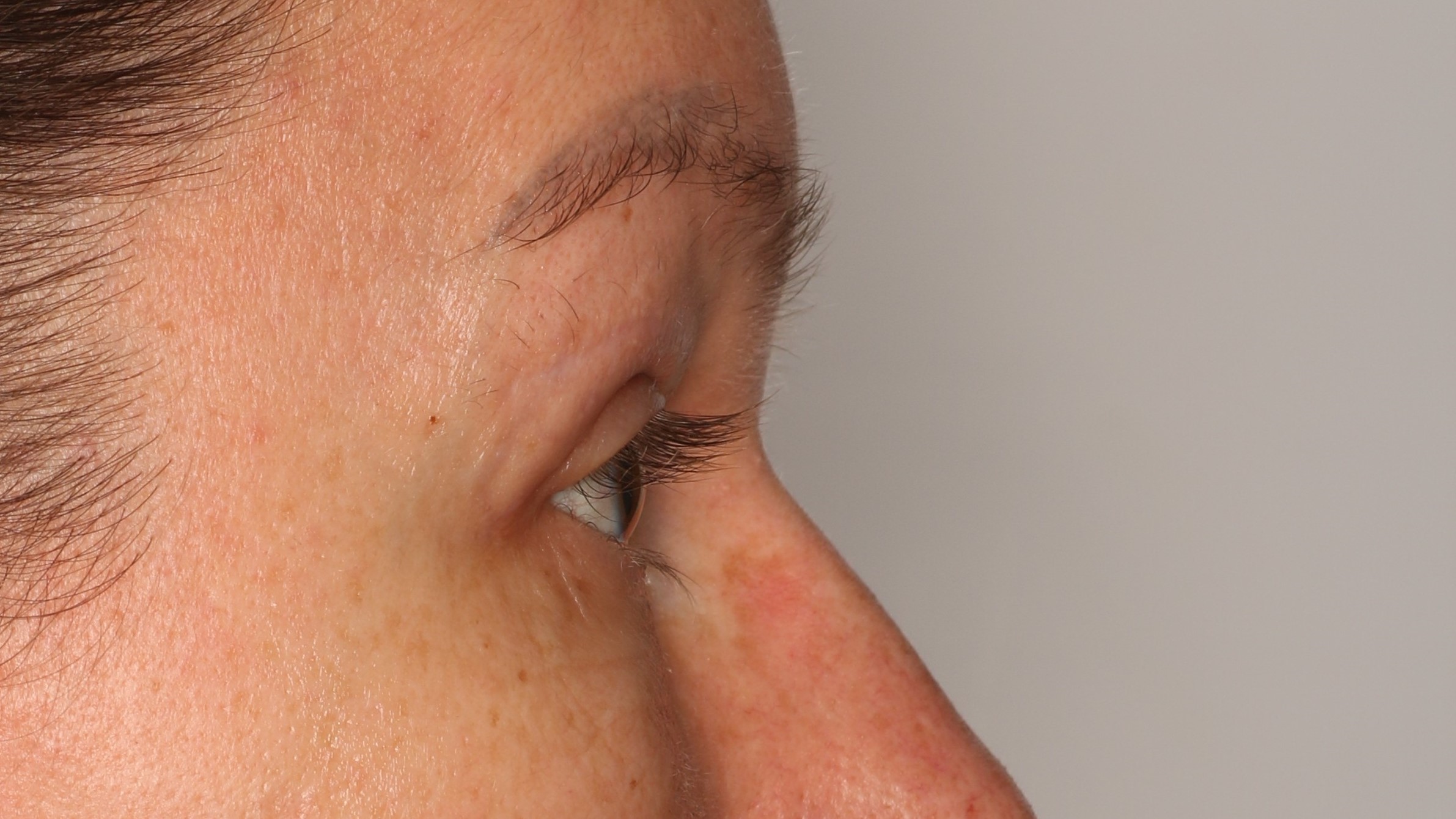 Efekt zabiegu plastyka powiek górnych - Po