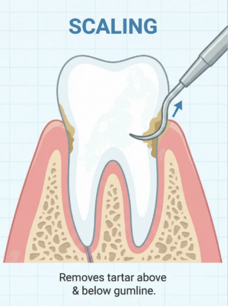 Dental Scaling in Toronto | Bloor-Yorkville Periodontics