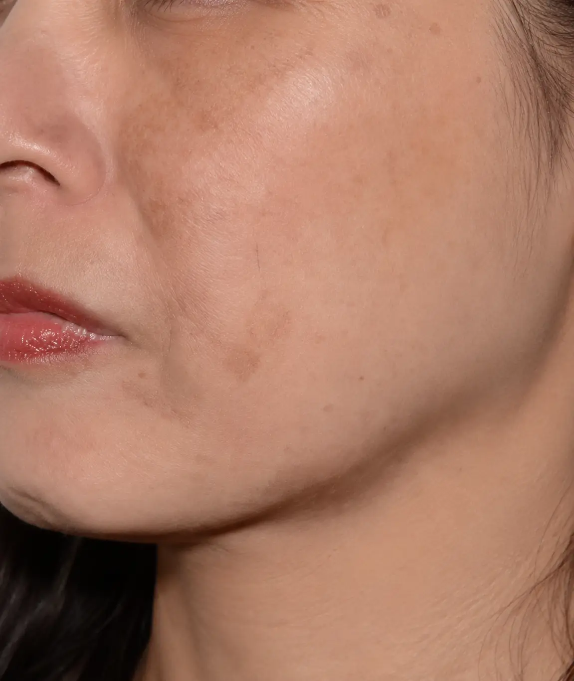 Facial skin displaying melasma hyperpigmentation patch on cheek.