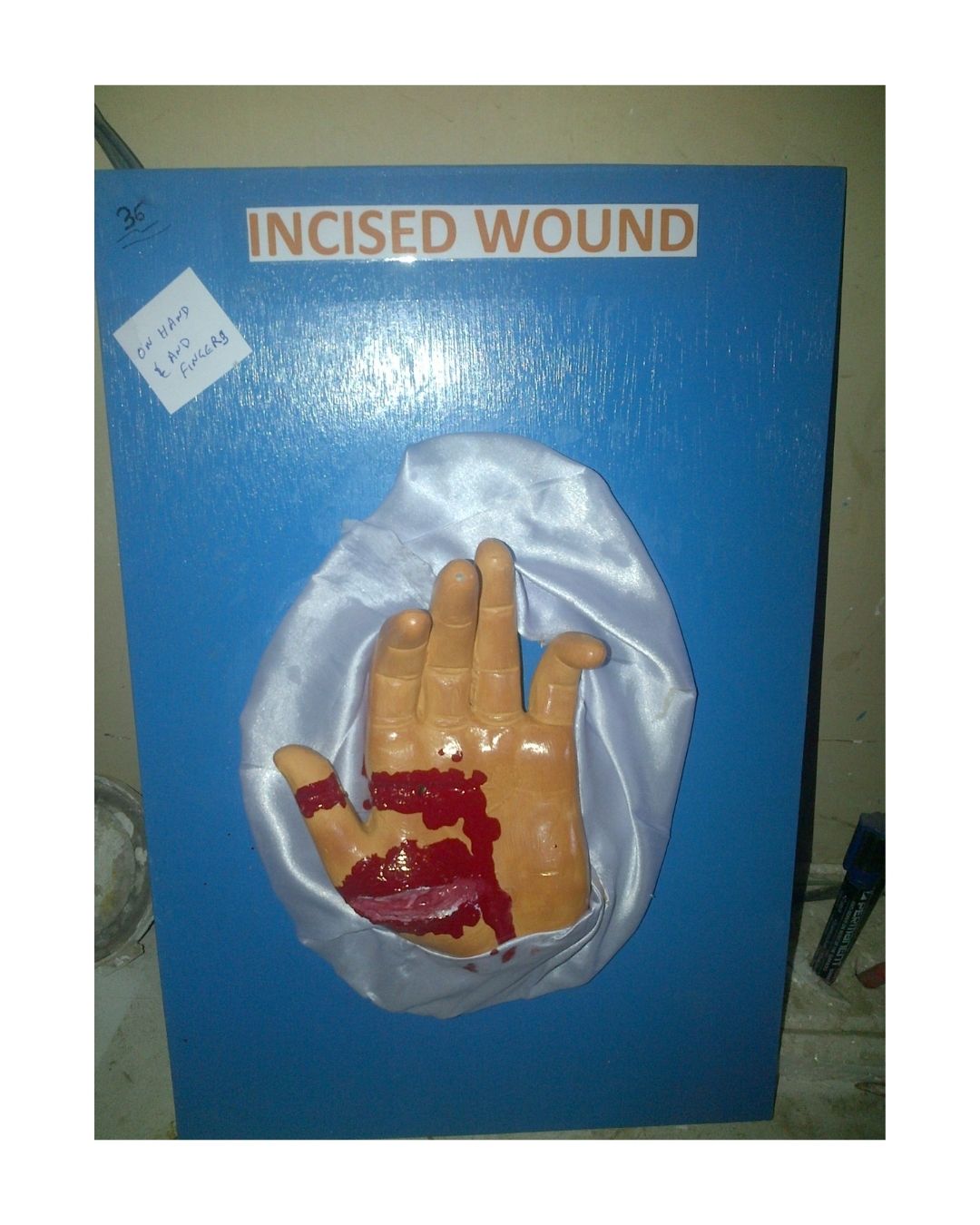 Incised Wound – Hand & Fingers