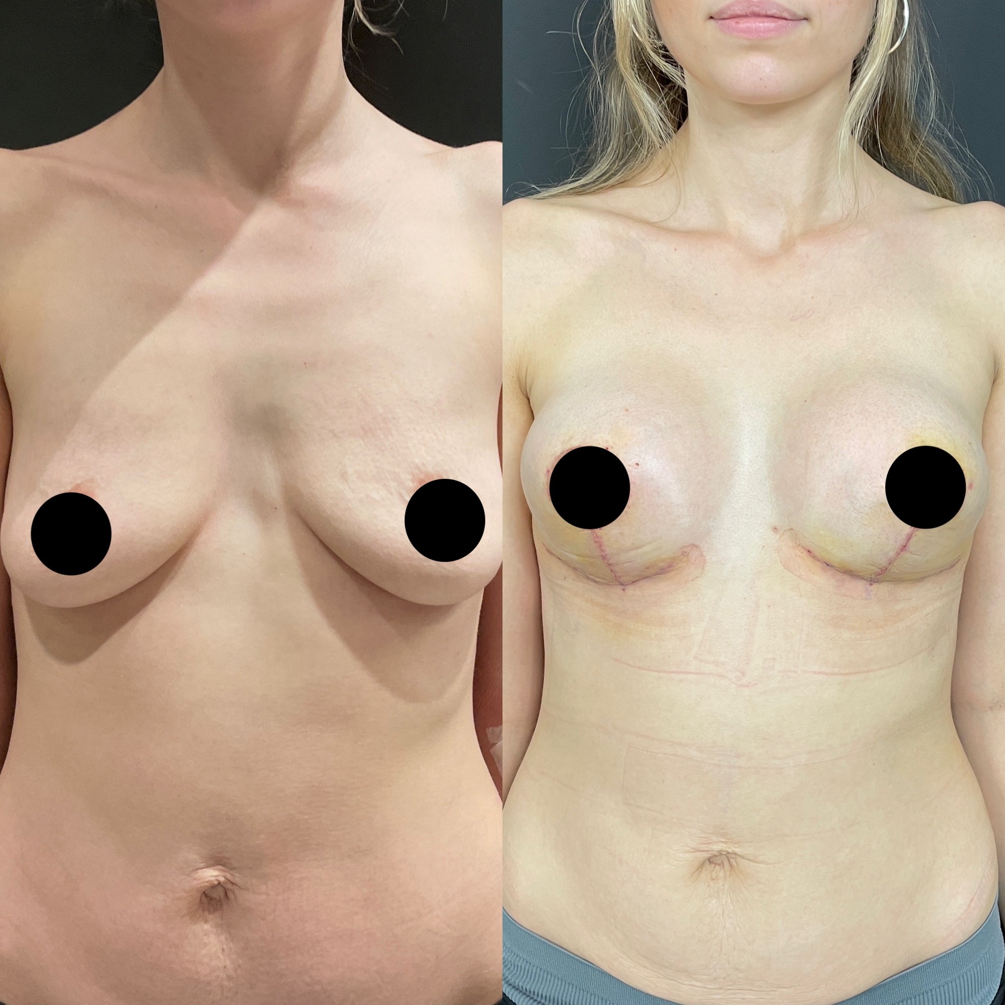 6th day before after breast lift with implant front view