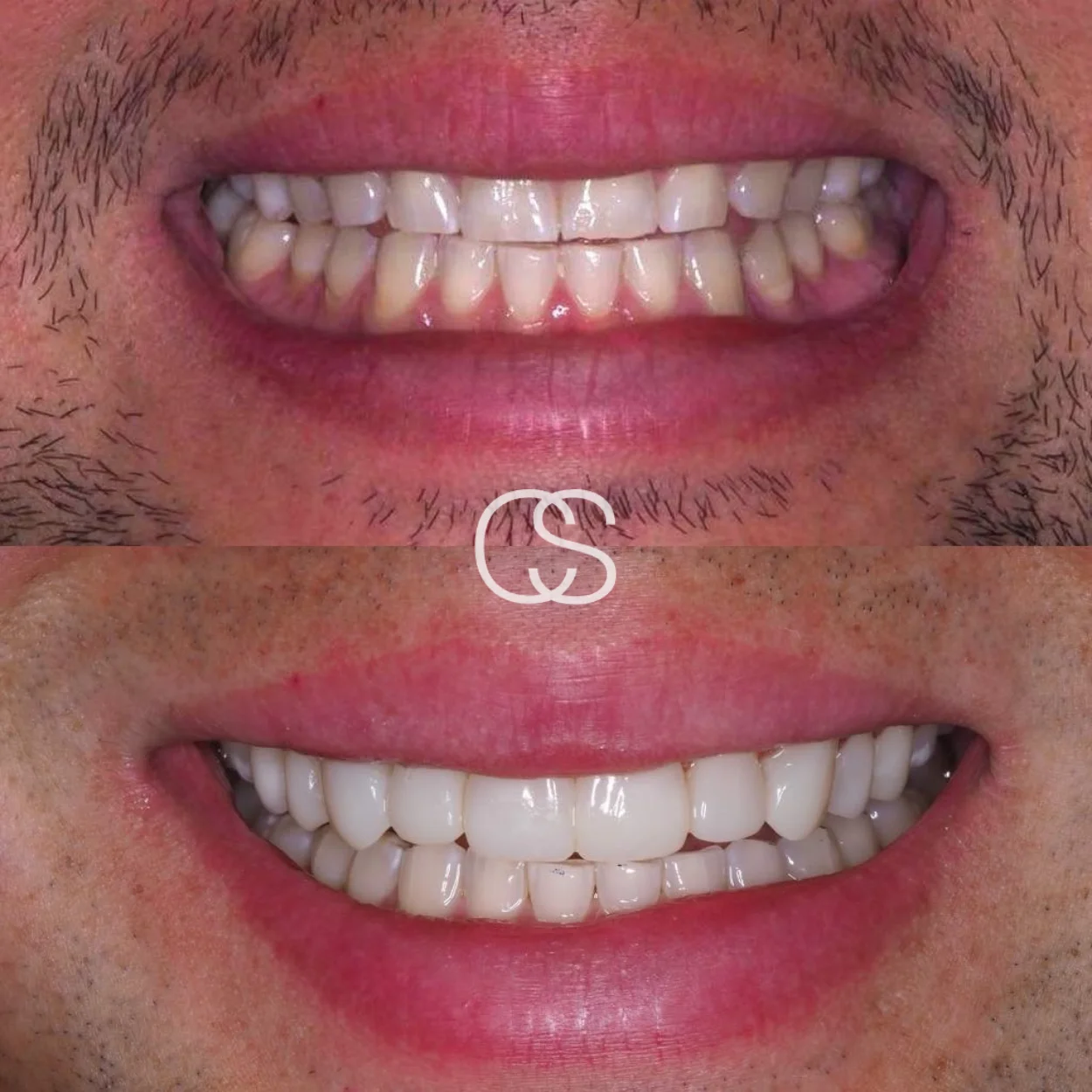Before & After Dental Crowns, Colac Smiles, Colac