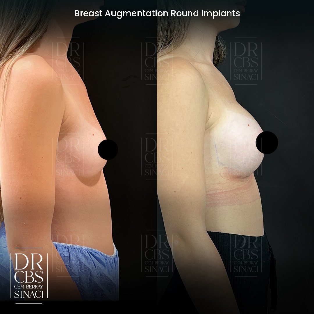 breast augmentation 2 weeks result right side view