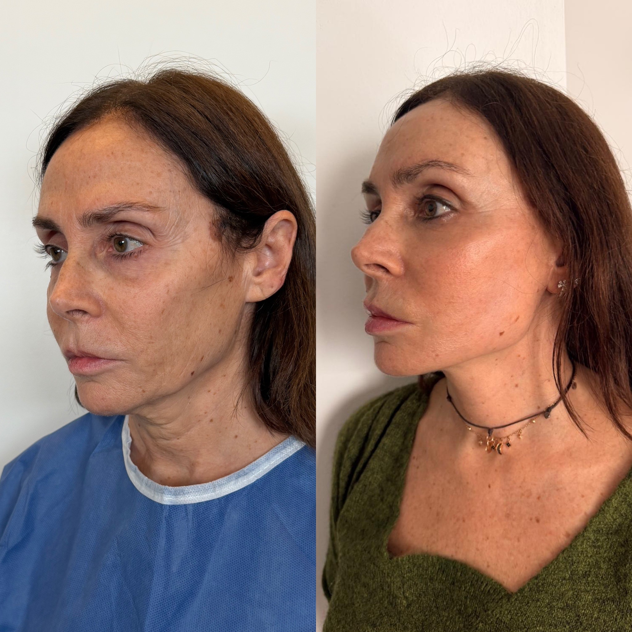 deep plane face and neck lift before after istanbul