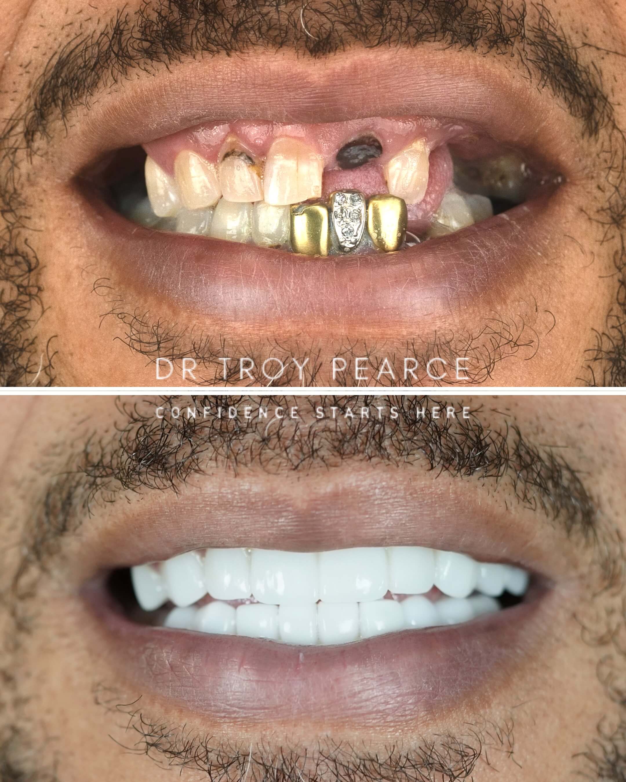 smiling before and after