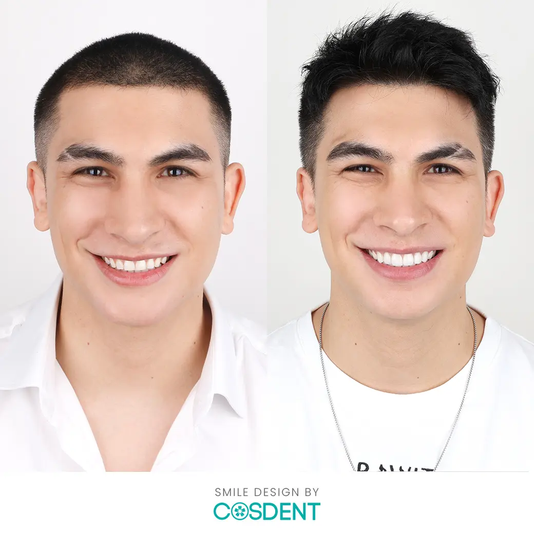 คุณลีโอ befor and after ออกแบบรอยยิ้มวีเนียร์ cosdent smile design