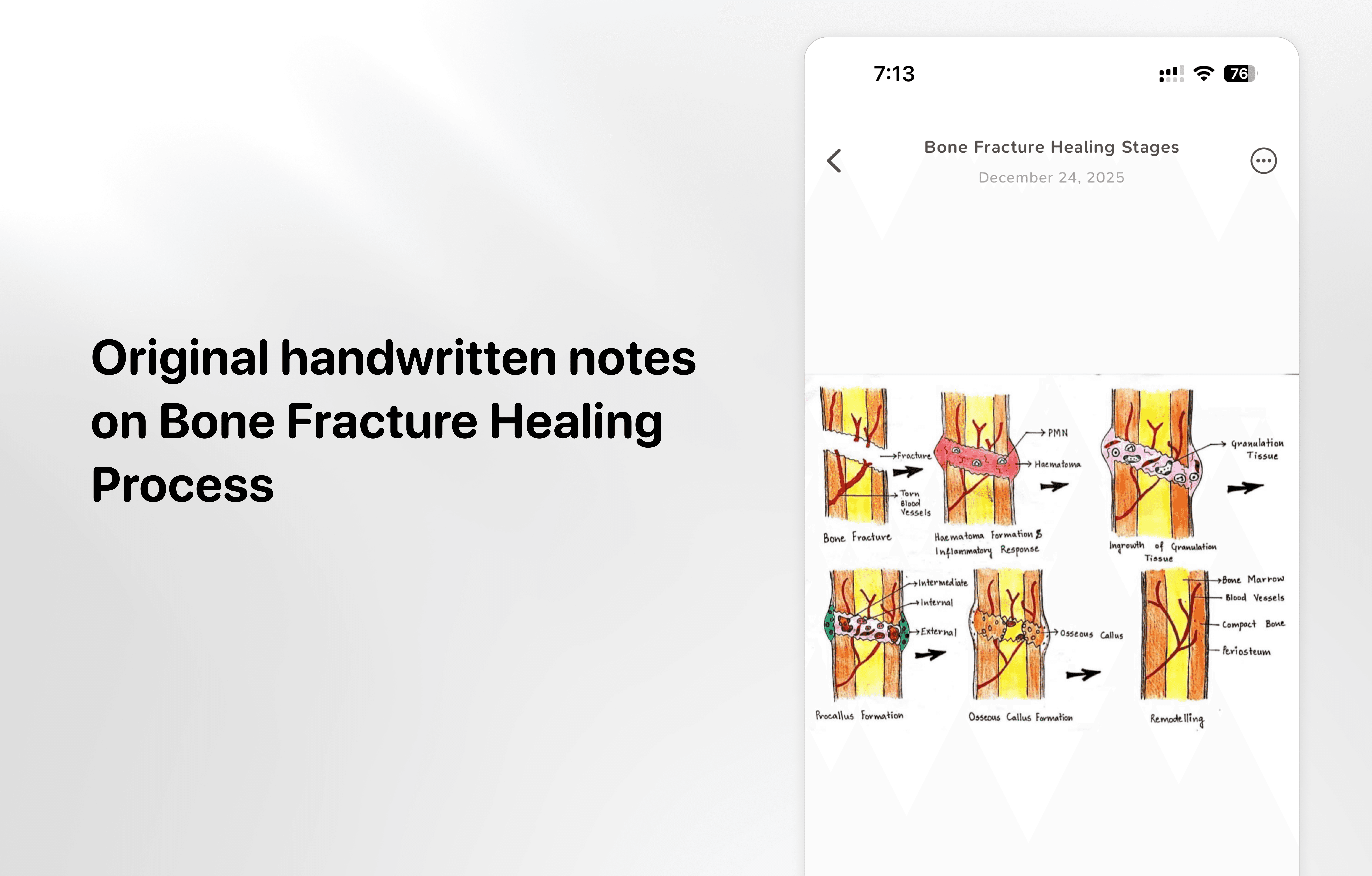 Original handwritten notes on Bone Fracture Healing Process
