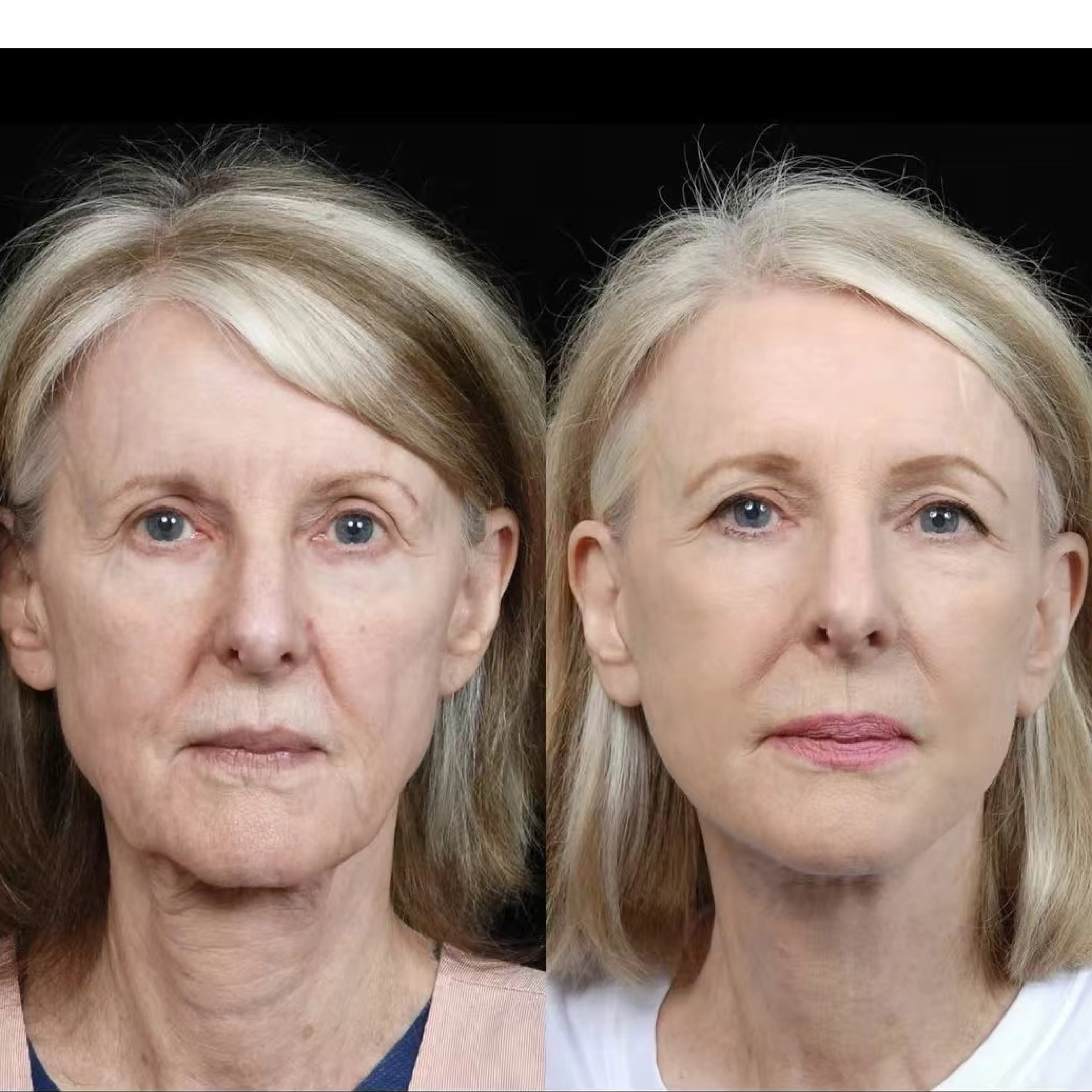 Poly(L-lactic acid)-PEG Microspheres Freeze-Dried Powder – Professional B2B Supplier for Injectable & Regenerative Applications