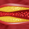 Lipoprotein(a) blood test identifying inherited cardiovascular disease risk factors