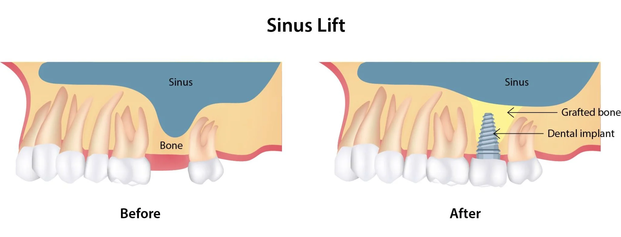 Sinus Lift in Toronto | Bloor-Yorkville Periodontics