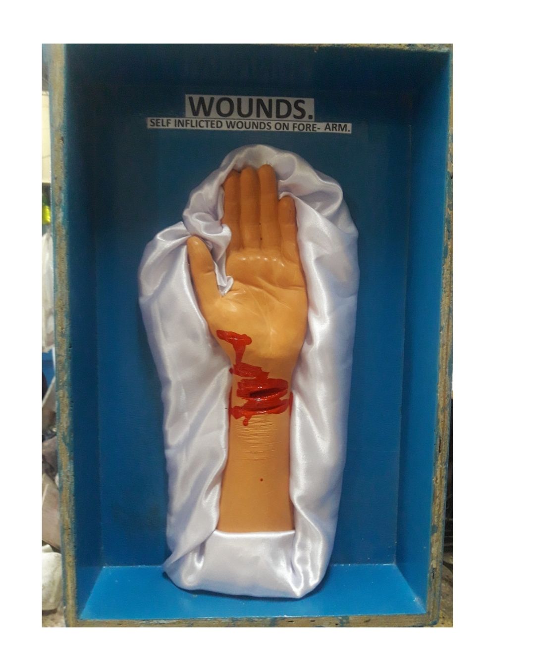 Self-Inflicted Wound on Forearm