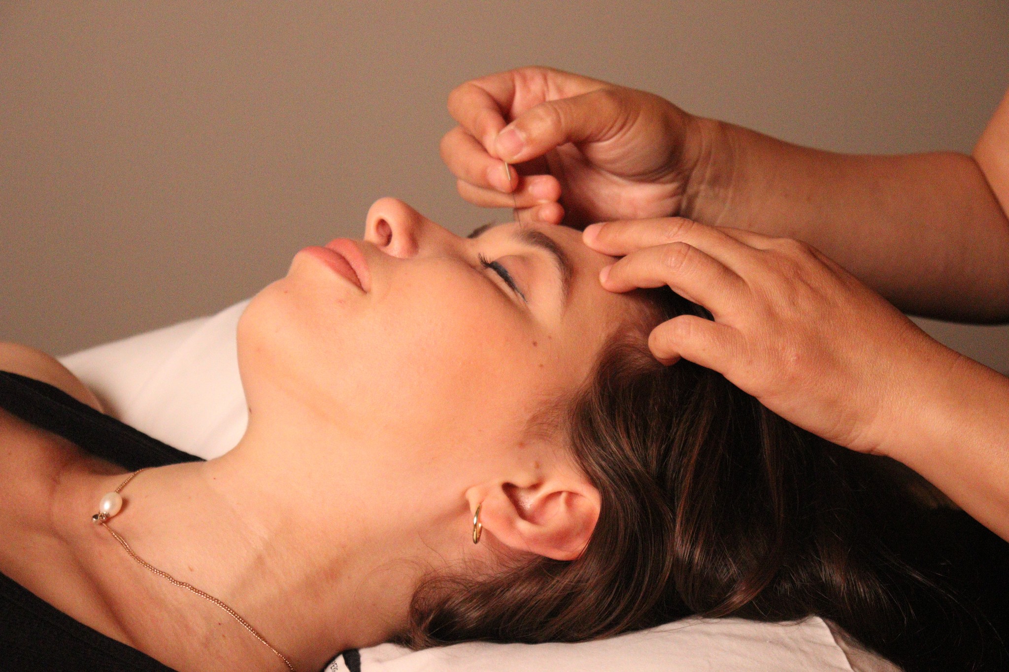 female patient receiving facial acupuncture on her forehead