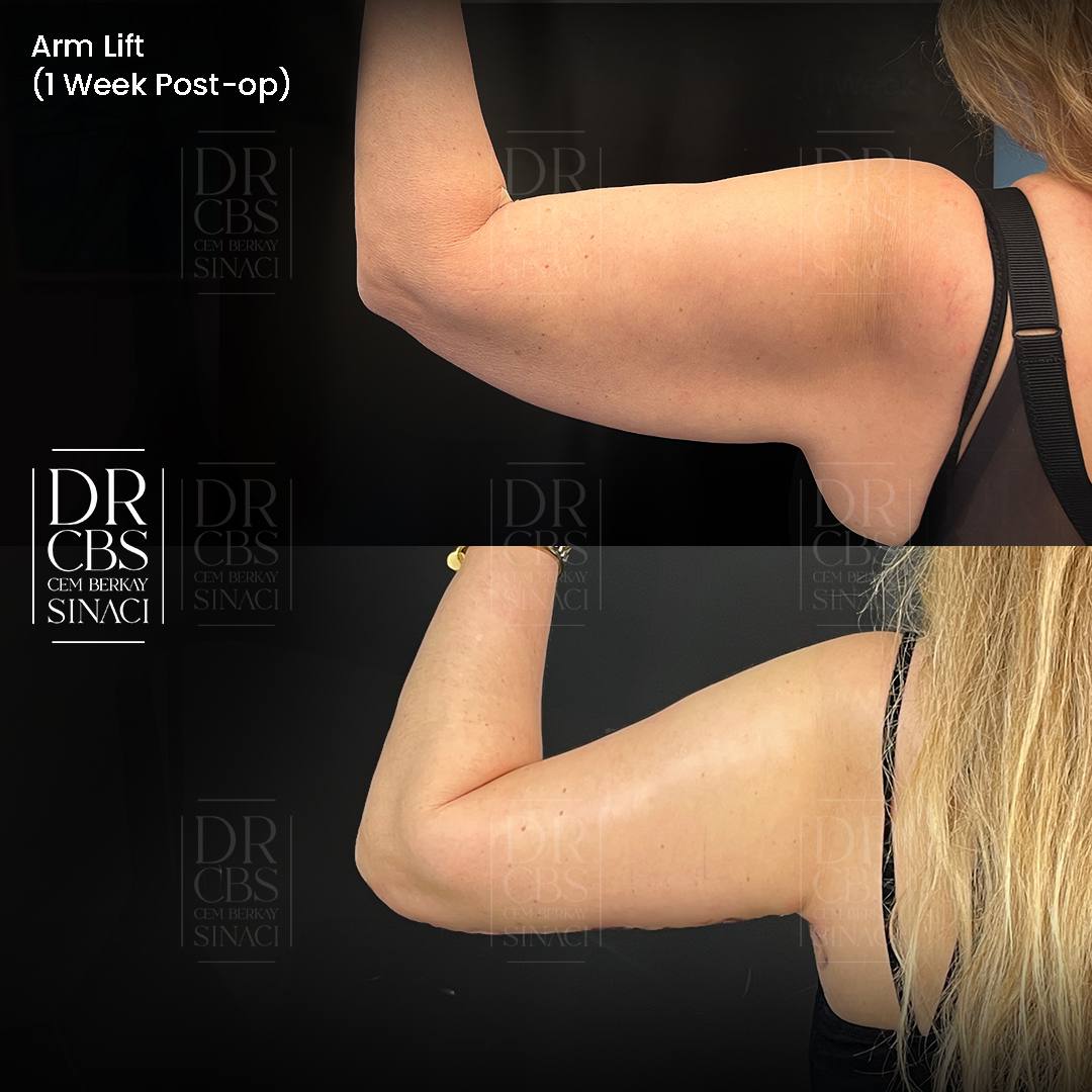 1 week post surgery before after photo of arm lift patient of Dr.CBS left arm