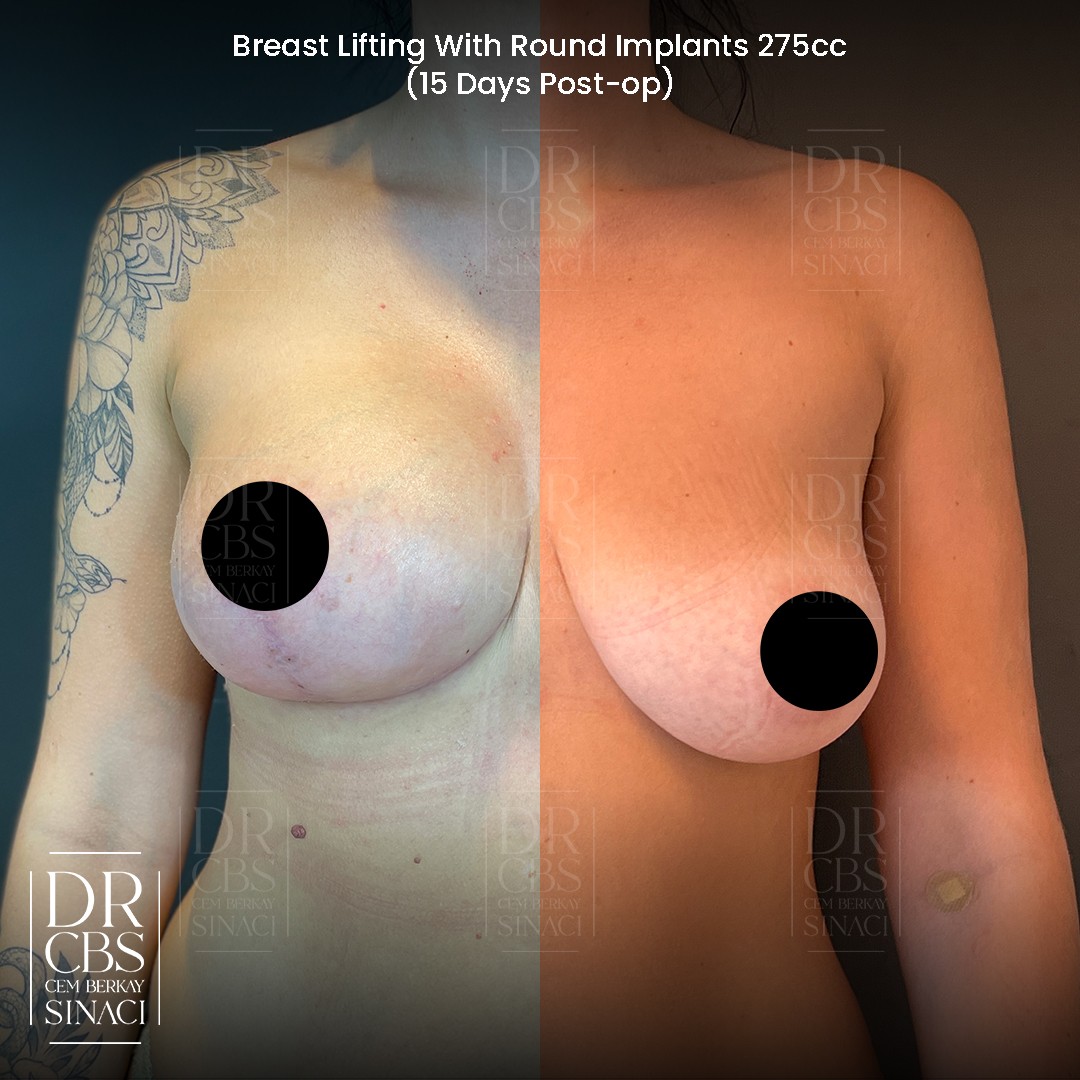 15 days result before after breast lift with implant mastopexy augmentation front view