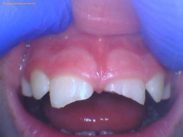 Close-up clinical image of a child’s upper front teeth before bonding treatment for dental trauma, showing a chipped front tooth with gloved hands lifting the lip.