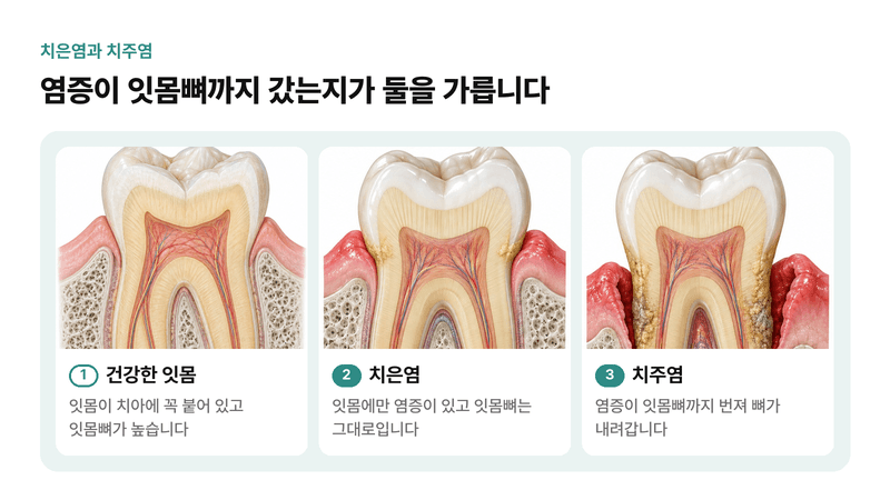 건강한 잇몸, 잇몸에만 염증이 있는 치은염, 잇몸뼈까지 염증이 번져 뼈가 내려간 치주염을 같은 치아 단면으로 비교한 일러스트