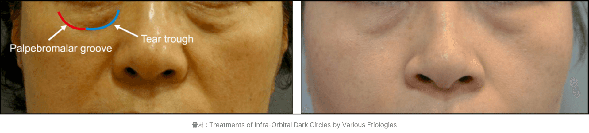 palpebromalar groove and tear trough dark circles structural dark circles