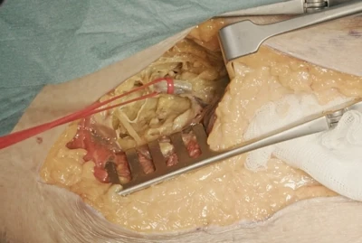 External iliac artery exposure