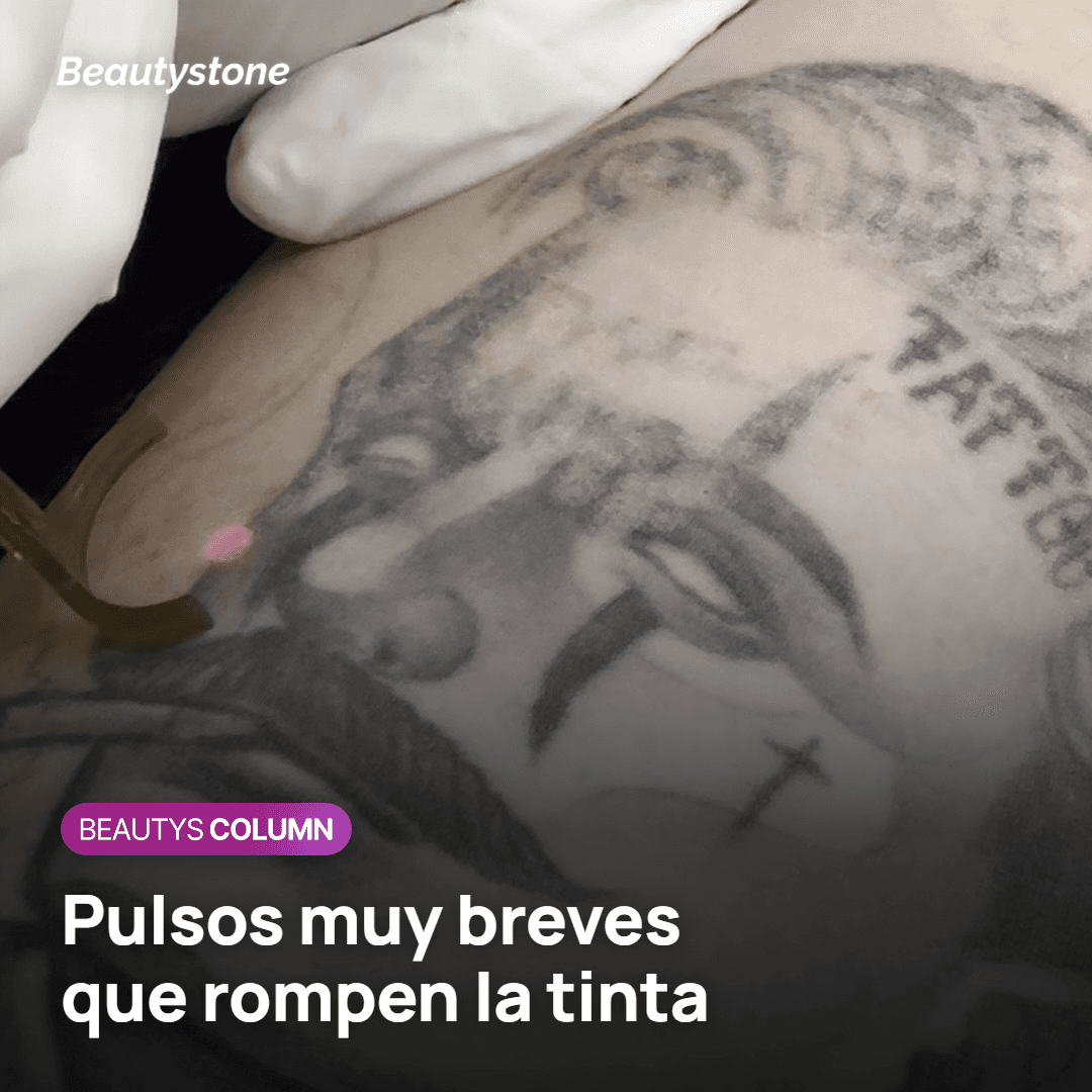 Láser PicoWay rompiendo la tinta de un tatuaje con pulsos de picosegundos