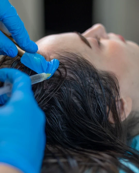 PRP treatment injection session.