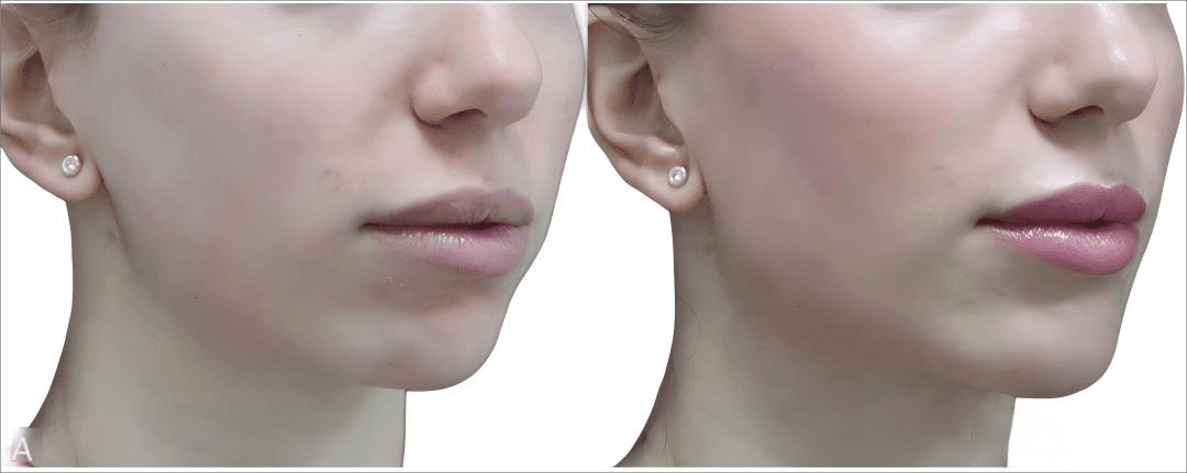 Four-month follow-up results for patients treated with two vials of L-lactic acid polyethylene glycol (one vial per side of the face)