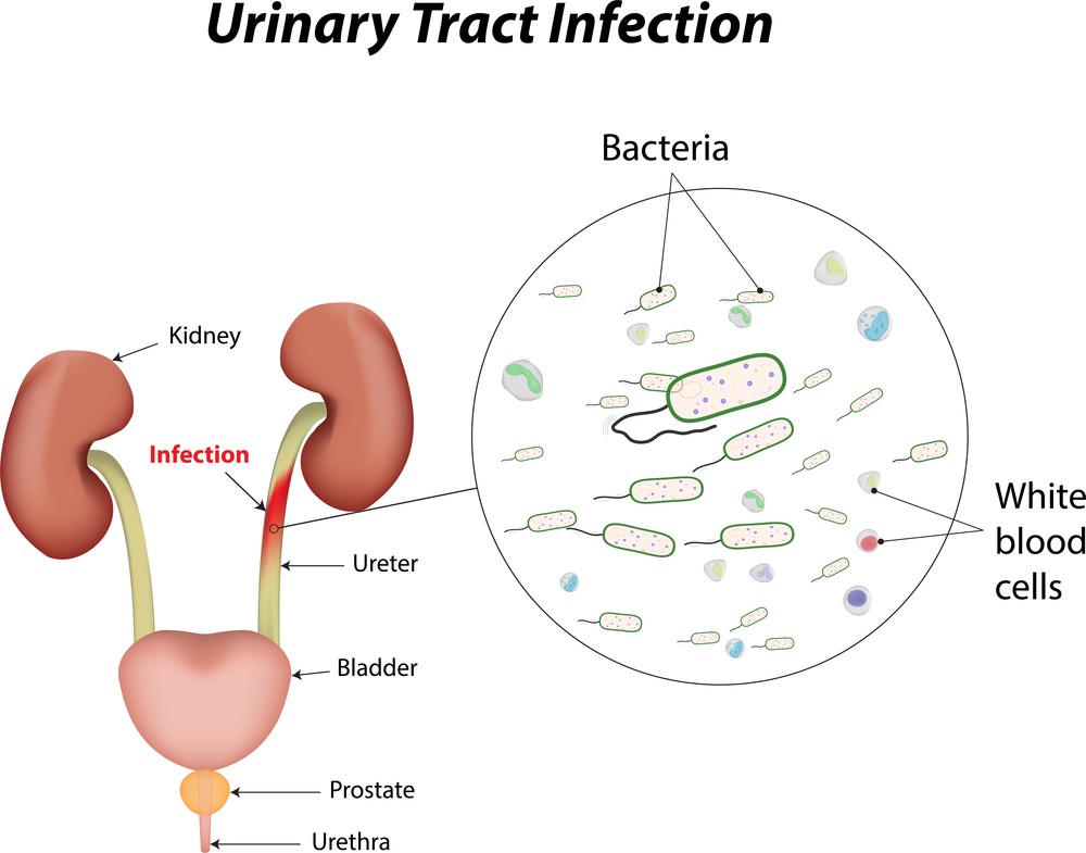 how does a woman get a urinary tract infection