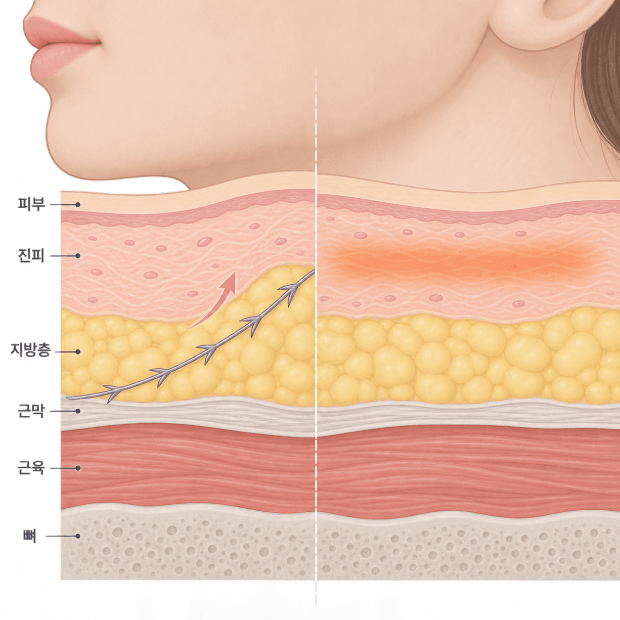 실은 지방층에서 조직을 걸어 올리고, 써마지는 진피를 넓게 데워요