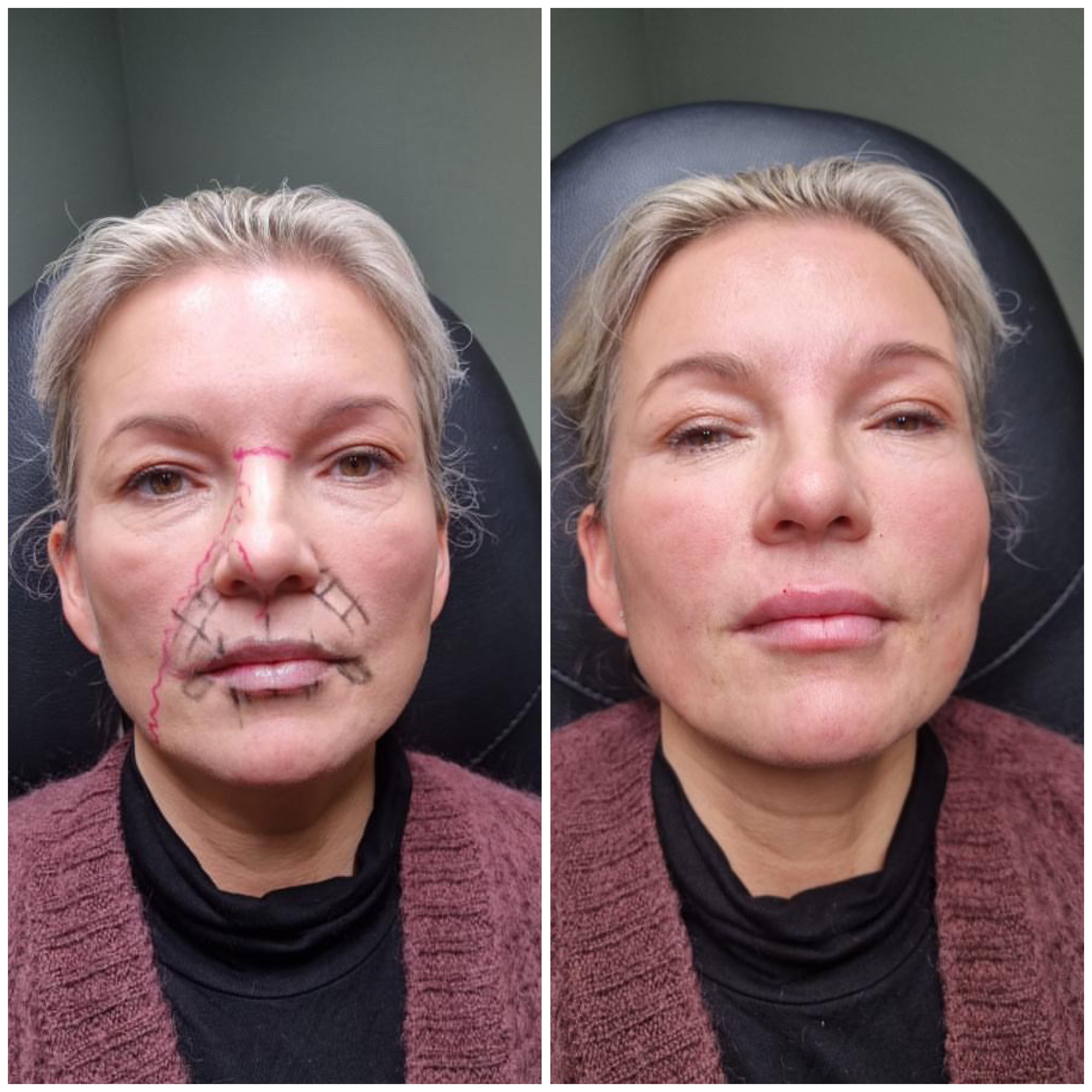 Naturligt resultat efter fillers med förbättrade ansiktsdrag