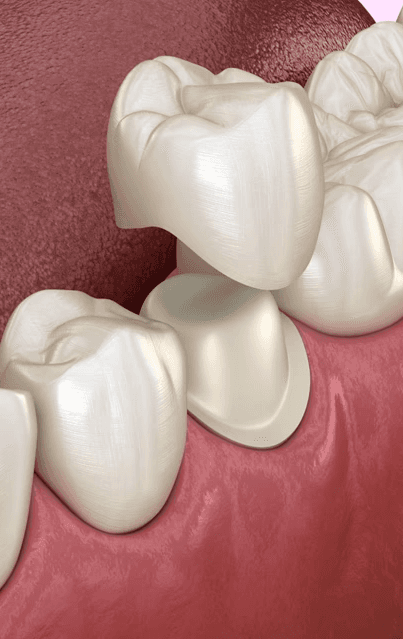 Same-Day Dental Crown Rochelle Park