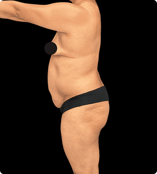 Antes de la abdominoplastia en Mendoza Plastic Surgery en Atlanta – paciente 2
