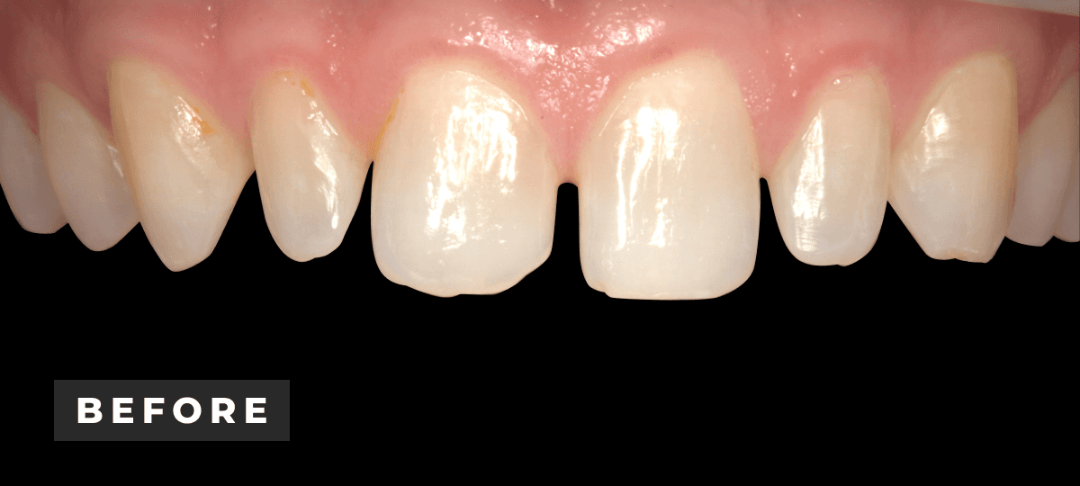 Before image of porcelain veneer and invisalign