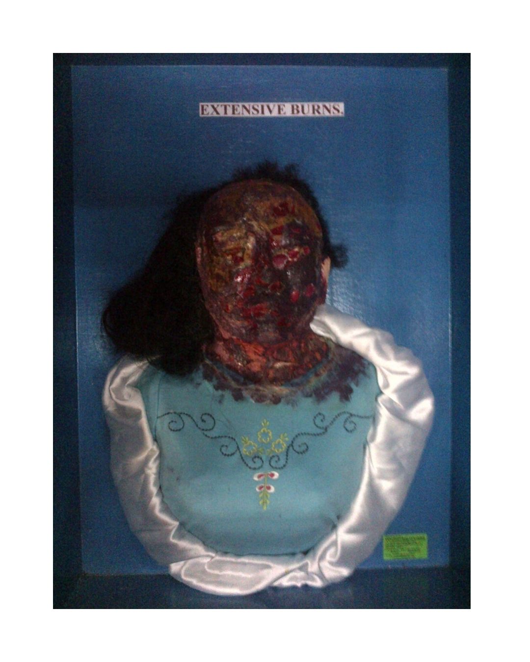 Extensive Burns (Face & Neck)