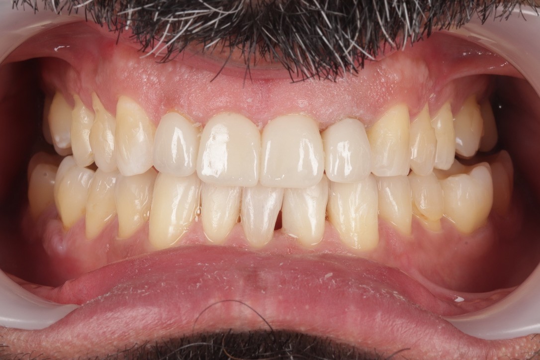 Case 02 after restorative dentistry treatment