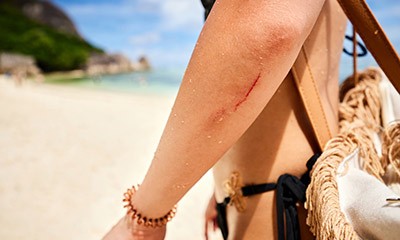 Woman with cut at the ocean