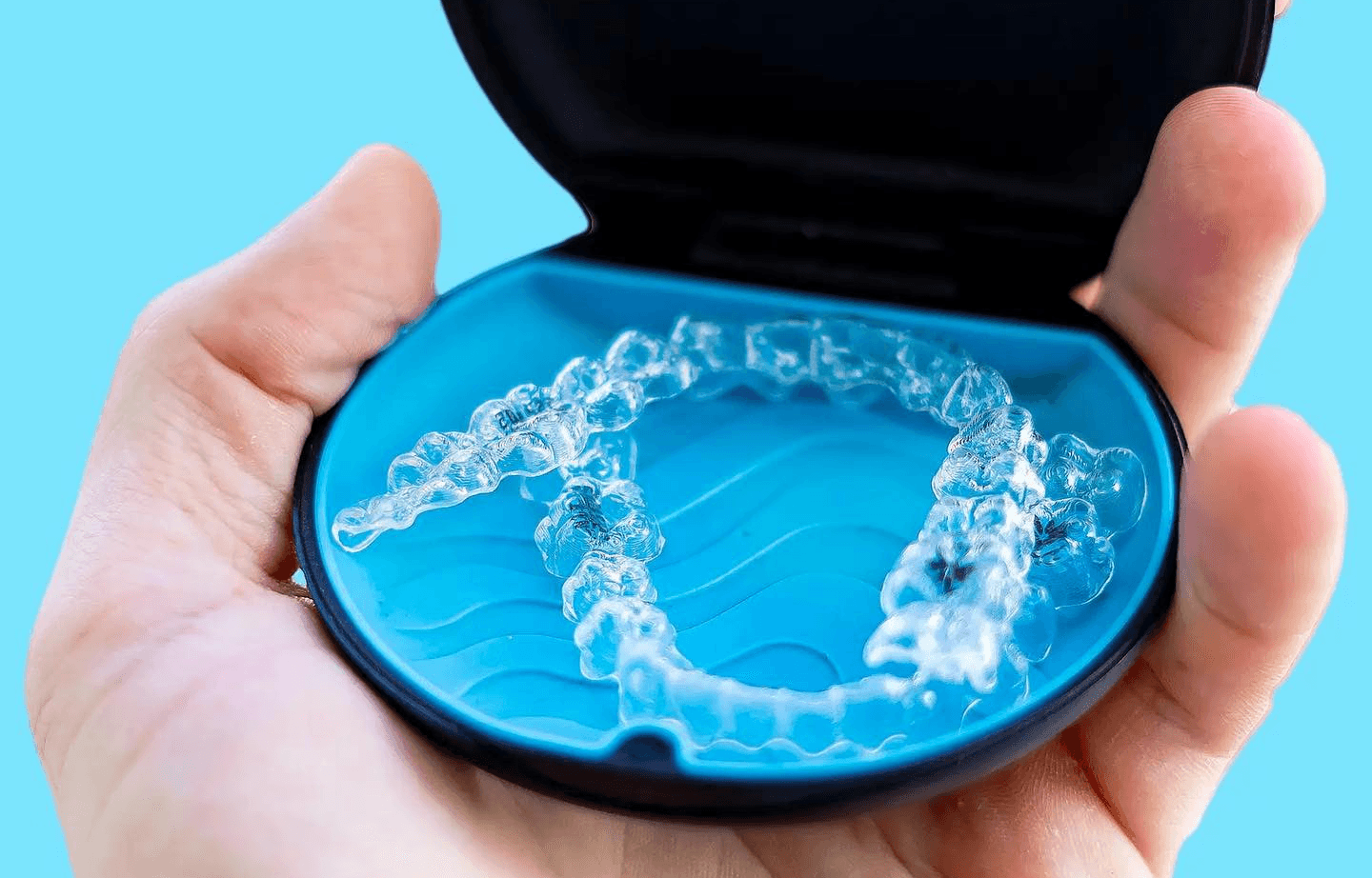 Clear aligners in a case for open bite treatment and teeth alignment 