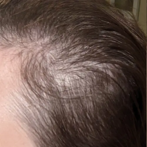 Before HydraFacial MD scalp treatment at The Vancouver Aesthetician — thinning hair and receding hairline visible