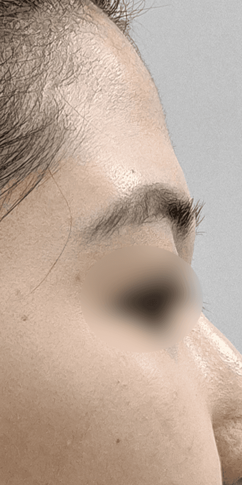 Forehead Filler - Before