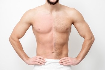 Mens Chest Laser Chelsea West Village