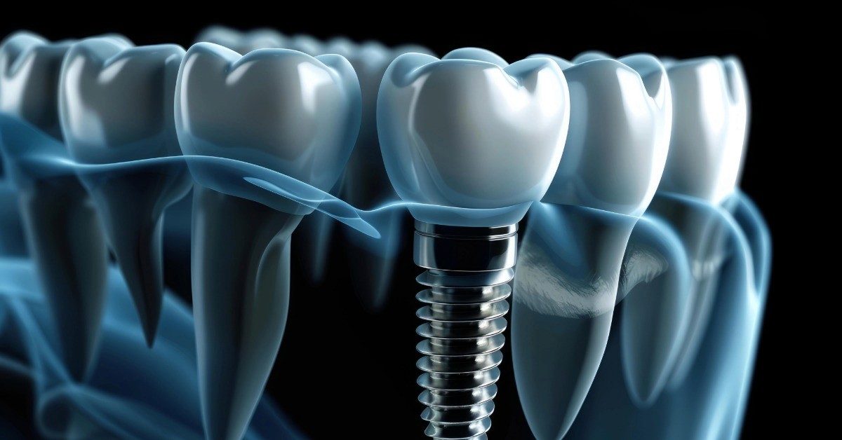 Implantologia Sudio Dentistico D'Agostino