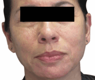 Before RF microneedling - Scar Remodelling