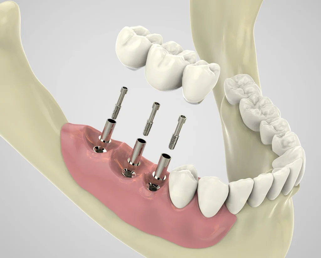dental implant procedure