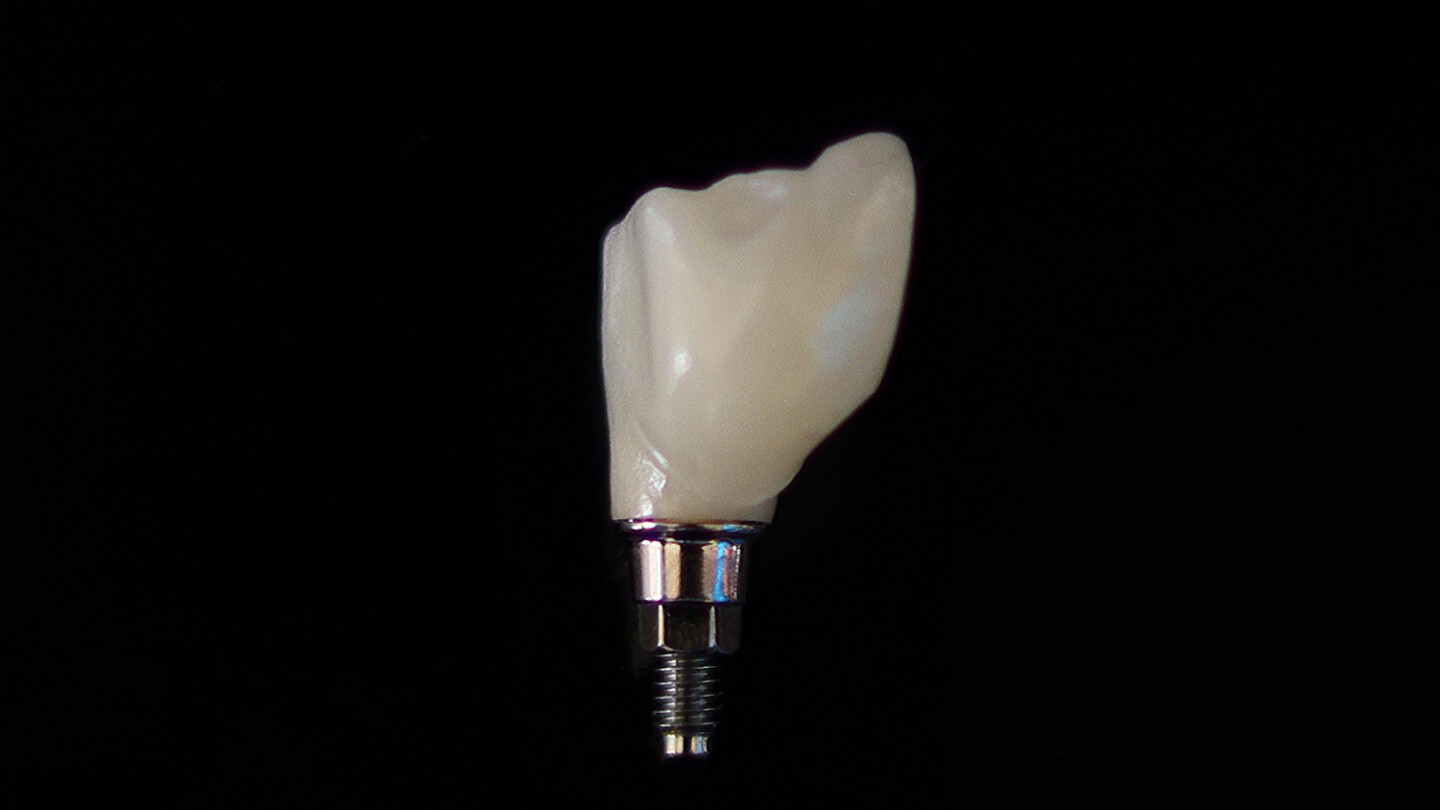 Costa Rica dental implants, Meza Dental Care for smile design & dental tourism.