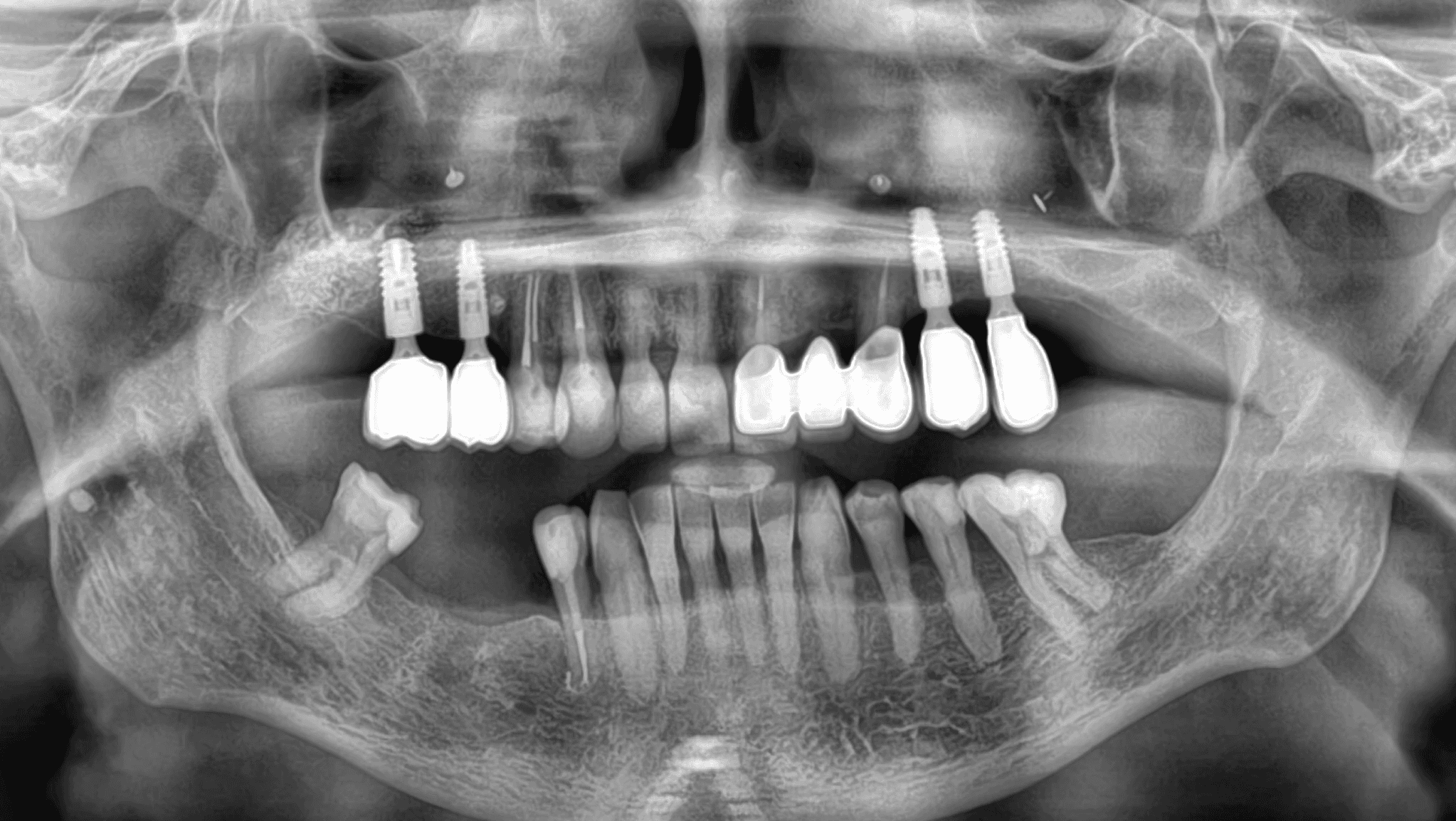 RTG snímka keramického mostíka a implantátov