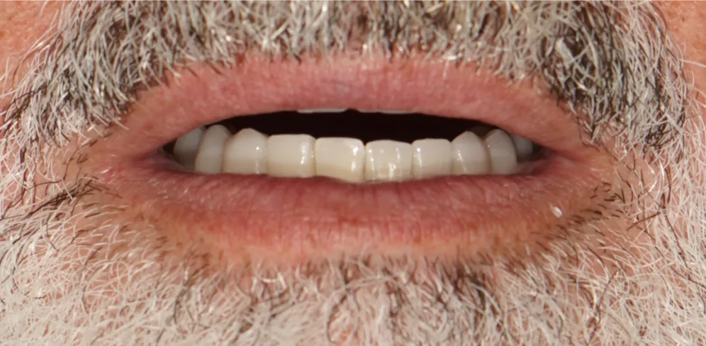 After ortho treatment