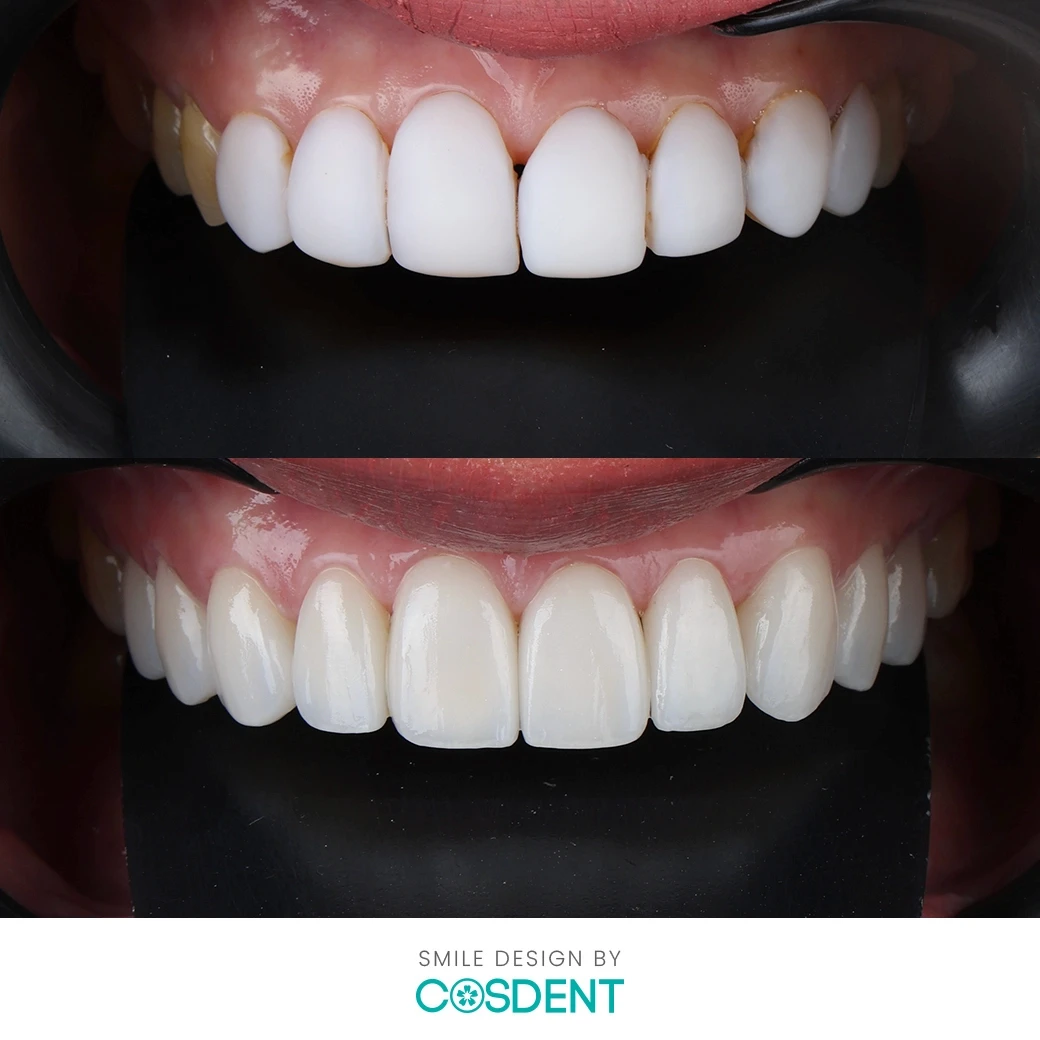 รีวิวออกแบบรอยยิ้ม ที่ cosdent smile design