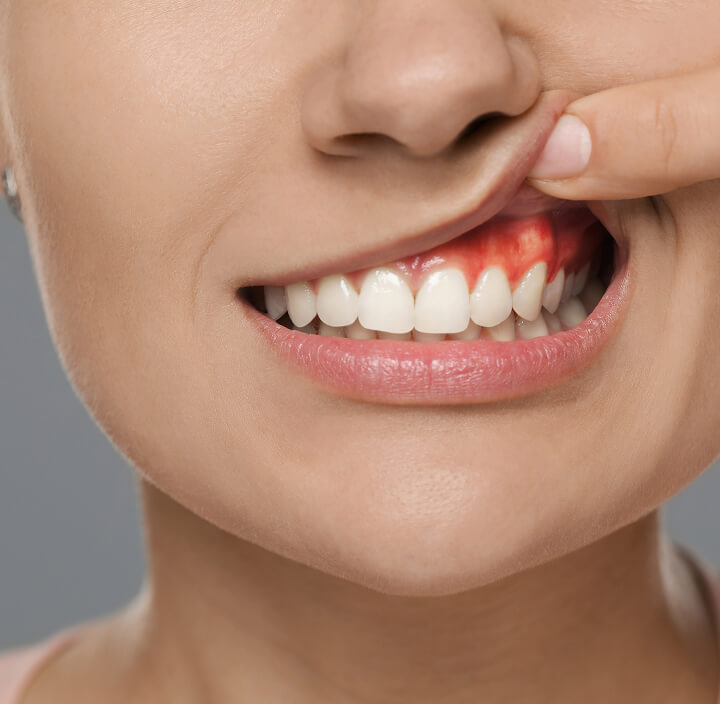 Gum Disease Treatment Rochelle Park